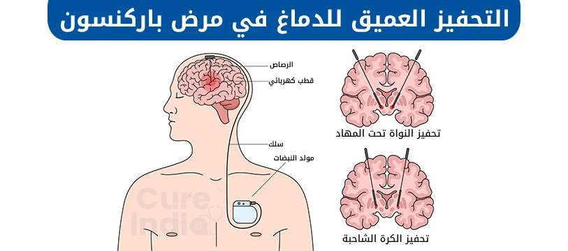 التحفيز العميق للدماغ في مرض باركنسون